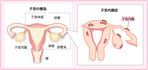 図：子宮の構造と子宮内膜症
